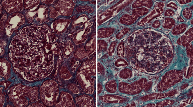 kidney sections from healthy control (left) and COVID-19 patient (right). Scar tissue is blue. CREDIT: Jitske Jansen and Bart Smeets, Radboudumc