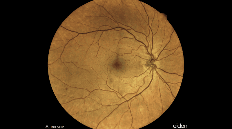 The fundus of the human eye is well perfused. When the vessels are photographed through the lens of the eye, neuronal networks can detect certain diseases on the basis of the images.Source: Mueller, S. und Wintergerst, M.W.M. et al. Multiple instance learning detects peripheral arterial disease from high-resolution color fundus photography. Sci Rep 12, 1389 (2022)