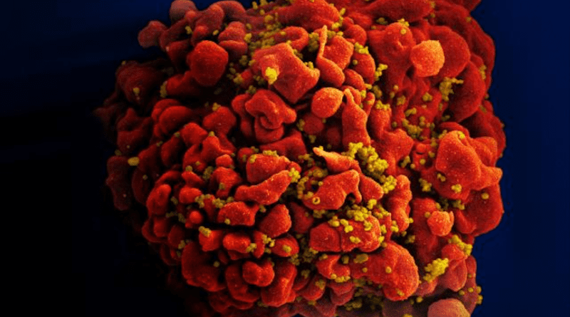 Scanning electron micrograph of an HIV-infected H9 T cell. CREDIT: NIAID