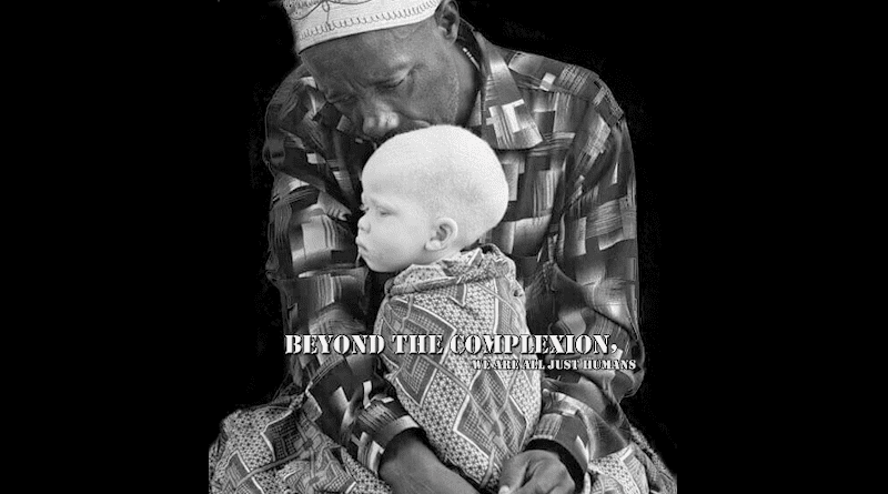 Awareness poster confronting prejudice against albinos in Africa. Credit: Zanna98, Wikipedia Commons