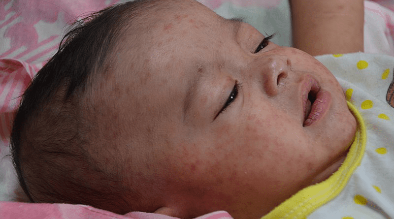 File photo of a Filipino baby with measles. Photo Credit: CDC Global, Jim Goodson, M.P.H., Wikipedia CommonsFile photo of a Filipino baby with measles. Photo Credit: CDC Global, Jim Goodson, M.P.H., Wikipedia Commons