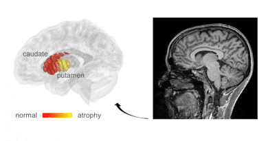 MRI images used for automatic detection of microstructural changes in early-stage Parkinson’s Disease (PD) patients. Marked in yellow are areas in the putamen where PD patients show tissue damage, compared to healthy controls. CREDIT: Mezer Lab/Hebrew University