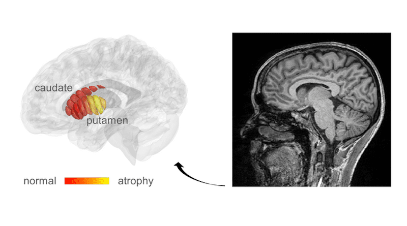 MRI images used for automatic detection of microstructural changes in early-stage Parkinson’s Disease (PD) patients. Marked in yellow are areas in the putamen where PD patients show tissue damage, compared to healthy controls. CREDIT: Mezer Lab/Hebrew University