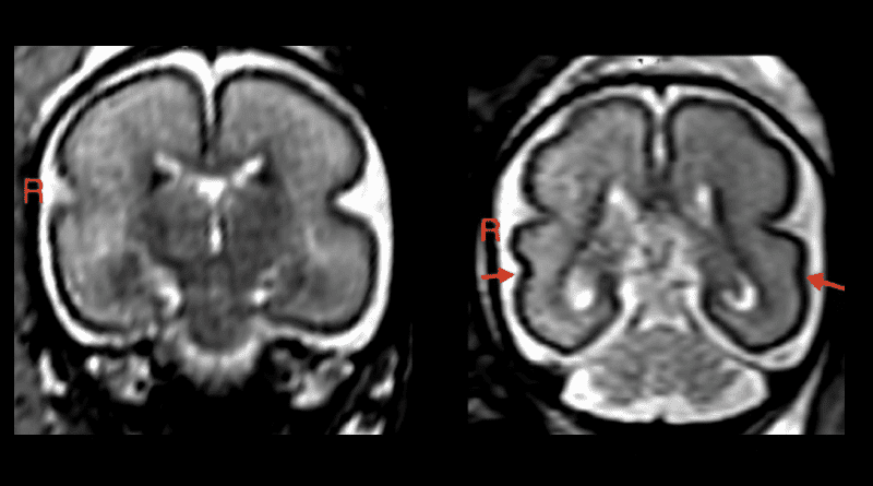 Left: Fetal brain post-intrauterine alcohol exposure in fetus between 25 and 29 gestational weeks. Note the smooth cortex in frontoparietal and temporal lobes. Right: Brain of matched healthy control case in fetus between 25 and 28 gestational weeks. The superior temporal sulcus is already bilaterally formed (red arrows) and appears deeper on the right hemisphere than on the left. CREDIT: RSNA and Patric Kienast, M.D.