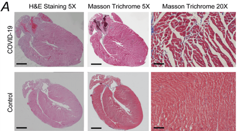 Hearts from mice infected with COVID-19 have an increased percentage of fibrosis and dilation of the fibers—a common indicator of early cardiomyopathy in mice CREDIT: Image courtesy of Andrew Marks.