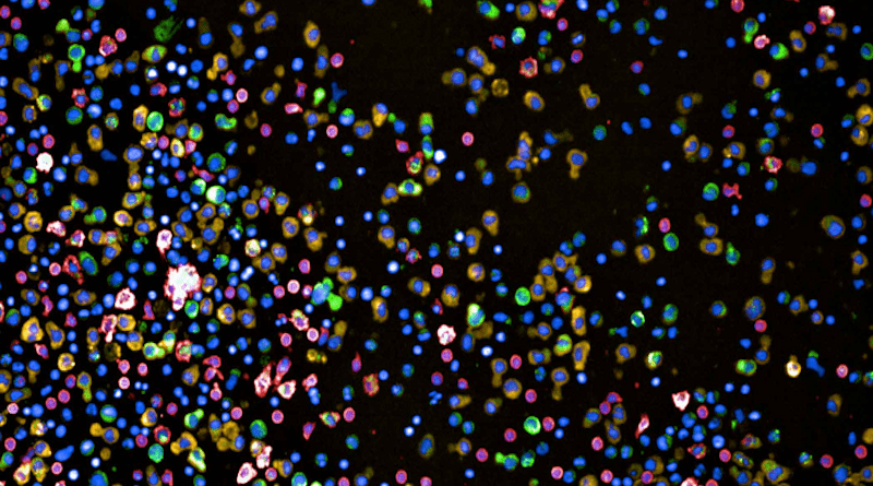 Bone-marrow cells of a multiple myeloma patient. Red cells are healthy monocytes, green and yellow are plasma cells. CREDIT: Berend Snijder Lab / ETH Zurich