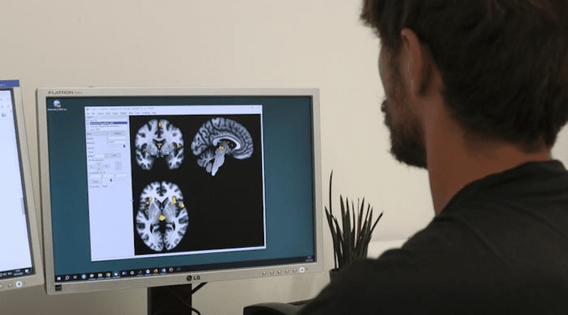 Using data from magnetic resonance imaging, the researchers were able to compare the brains of healthy and fibromyalgia sufferers. CREDIT: © Benjamin Mosch