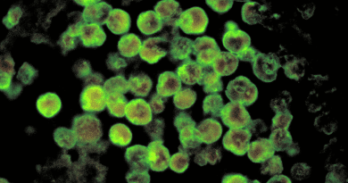 Histopathology of amebic meningoencephalitis due to Naegleria fowleri. Direct fluorescent antibody stain. Photo Credit: CDC/ Dr. Govinda S. Visvesvara, Wikipedia Commons