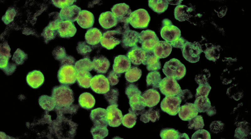 Histopathology of amebic meningoencephalitis due to Naegleria fowleri. Direct fluorescent antibody stain. Photo Credit: CDC/ Dr. Govinda S. Visvesvara, Wikipedia Commons