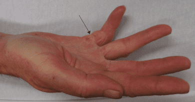 Dupuytren's (Viking disease) contracture of the right little finger. Arrow marks the area of scarring. Photo Credit: James Heilman, MD, Wikipedia Commons