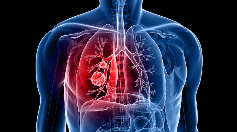 Significant progress in small-cell lung cancer research (Copyright (c) 2009 SciePro/Shutterstock).