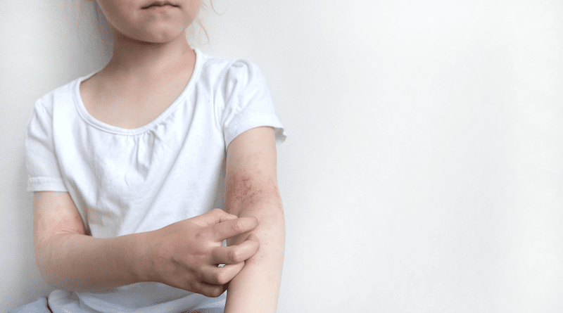 Atopic dermatitis: viruses discovered as new therapy option (Copyright (c) 2022 marishkaSm/Shutterstock).