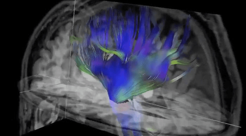 Diffusion tensor imaging, an MRI technique, of the brain. CREDIT: RSNA/Michael L. Lipton, M.D., Ph.D.