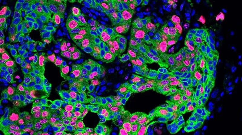 For a recent CSHL Cancer Center study, Adjunct Professor Mikala Egeblad (now a Bloomberg Distinguished Professor with Johns Hopkins University) and postdoc Xue-Yan He (now Assistant Professor of Cell Biology & Physiology at Washington University School of Medicine in St. Louis) teamed with CSHL Professor Linda Van Aelst. Above: lung cancer metastasis in a mouse that underwent experiments designed to simulate the stress that cancer patients experience. CREDIT: Egeblad lab/Cold Spring Harbor Laboratory
