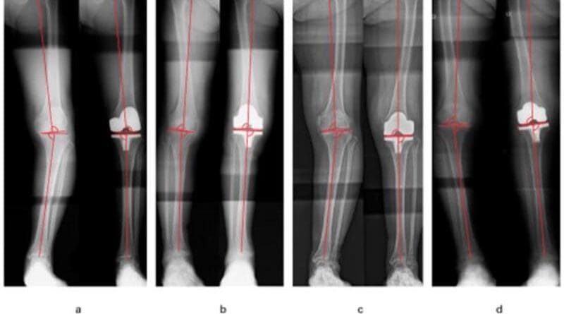 Toward Better Surgical Outcomes In Patients Undergoing Knee Replacement ...