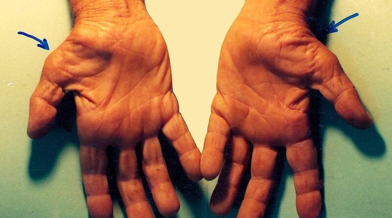 Untreated Carpal Tunnel Syndrome. Photo Credit: Dr. Harry Gouvas, MD, PhD, Wikipedia Commons